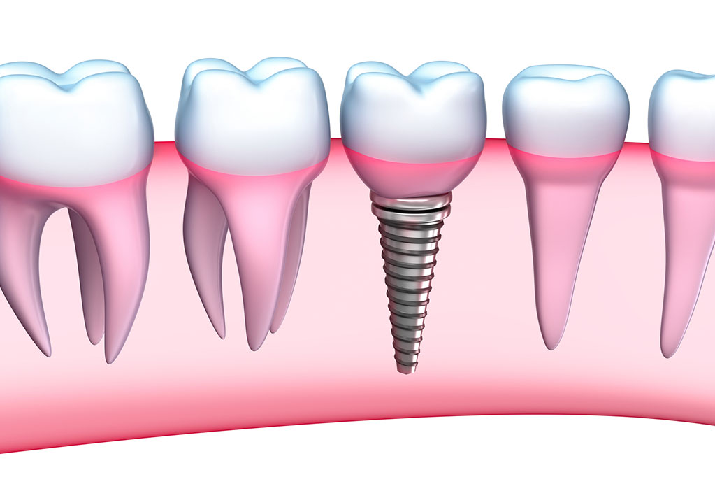 Dental Implants in Hamilton, NJ Hamilton Dental